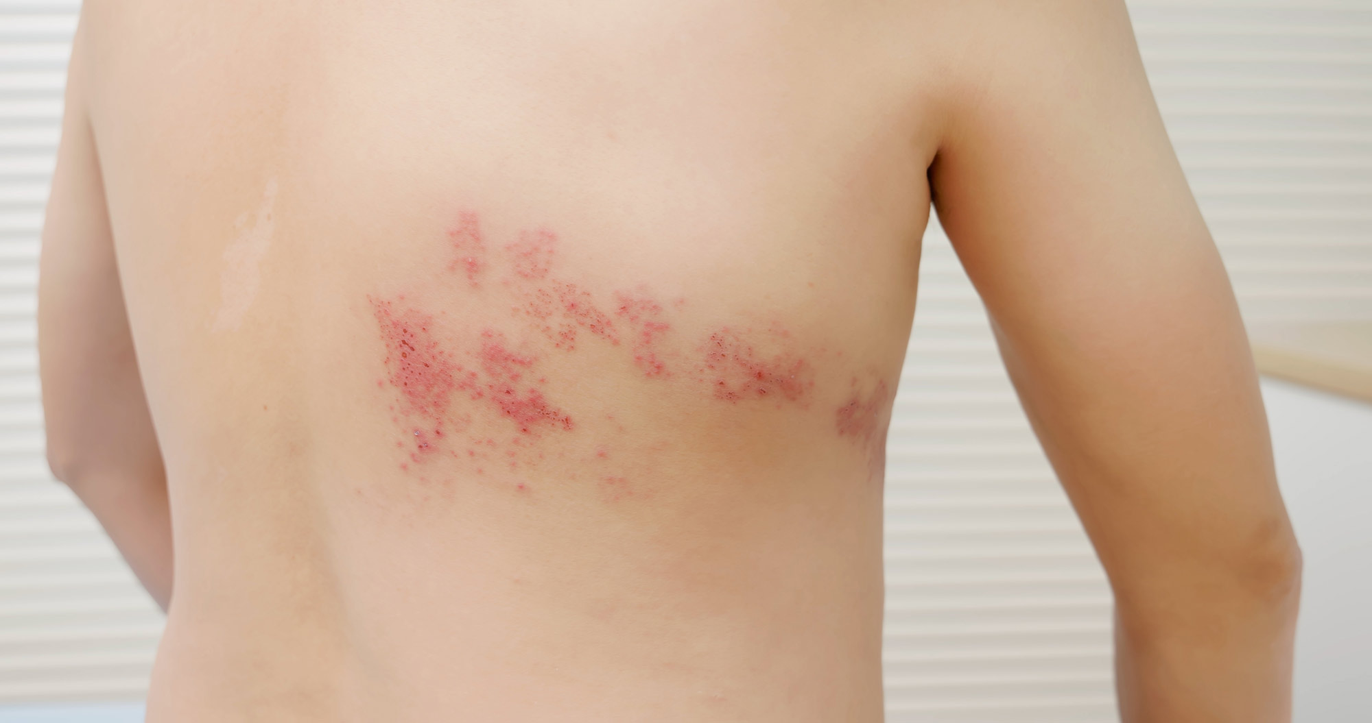 Shingles on a man's back
